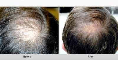 QR678 Treatment for Hair Growth Location Pan India