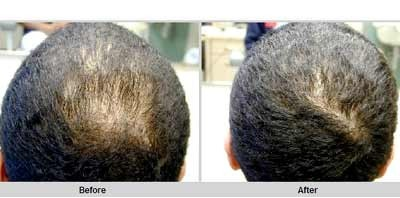 QR 678 injection for Hair Growth  Best Hair Loss Solution By Dr Rinky  Kapoor  YouTube
